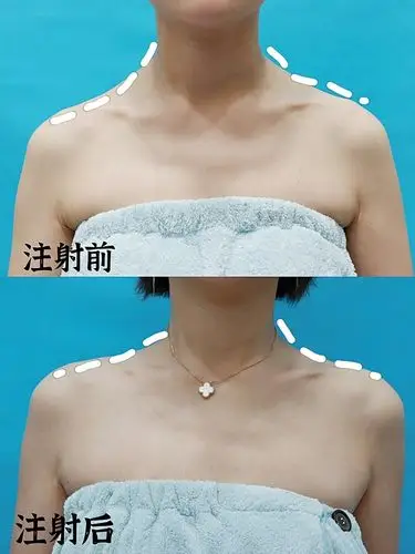 哈喽~7070这是我打完韩国瘦肩针1个月后的对比效果.