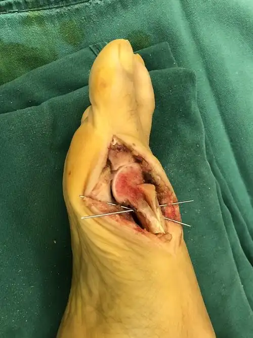 拇外翻病例诊疗分享_拇外翻_拇外翻治疗方式 - 好大夫在线