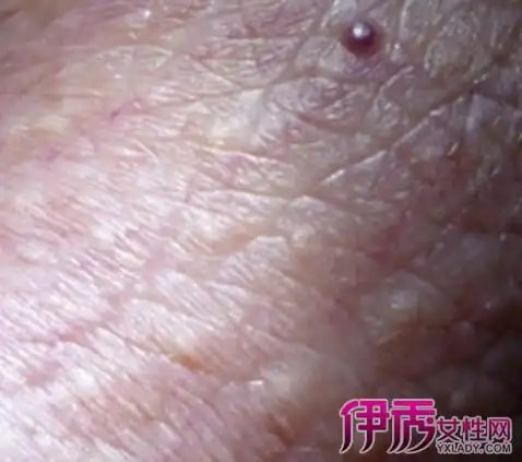 【图】阴囊长毛细血管瘤怎么治疗 该病3大危害大揭秘