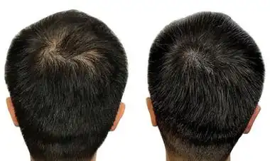 男性头顶植发加密对比