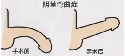阴茎弯曲怎么办?