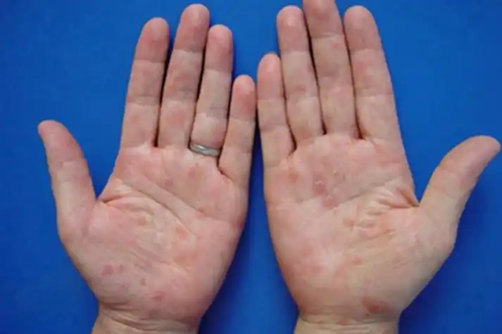 女性梅毒手掌斑块图