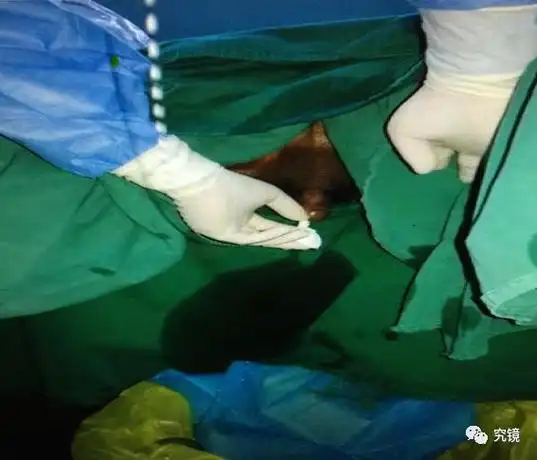 手术视频手术视频手术体位先取膀胱截石位,常规于左侧上尿路置入f6输