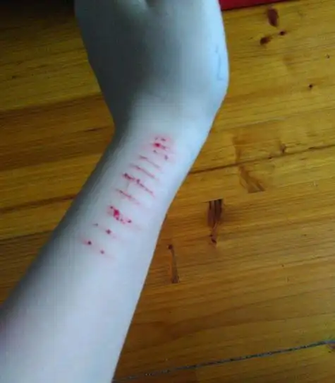 因为这些事,哈尔滨一16岁花季女孩自残20余刀!刀刀见血