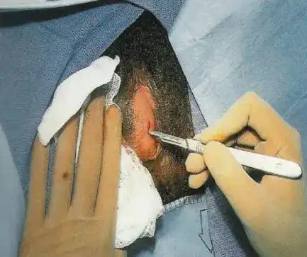 前庭大腺肿得像苹果一不小心就反复中招