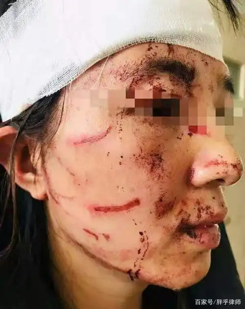 被丈夫及公公打至面部伤痕累累,不要再沉默,律师谈《反家暴法》