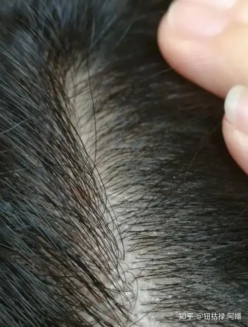 脂肪粒就是头皮出油太严重,因为头皮只有毛囊没有毛孔油脂分泌多了就