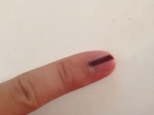 指甲上有一道黑线,随着指甲跟着长,望解答.