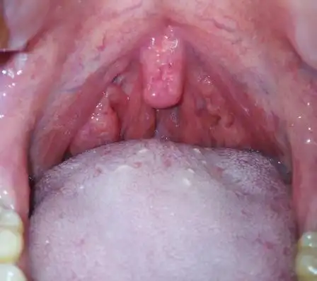 喉咙正常不发炎应该是什么样的,让我们一起看一看吧