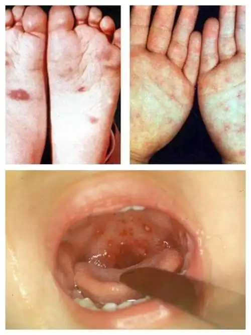 写美篇手足口病潜伏期一般2～7天,无特别征兆,多数宝宝突然起病!