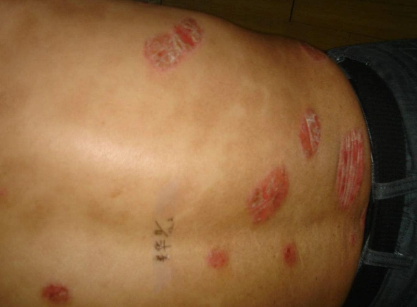 桃花藓症状图片 (1)_有来医生