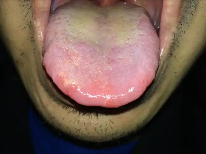 有那位懂中医的医生帮我看看我的舌苔是怎么回事,要怎么调理啊,这病