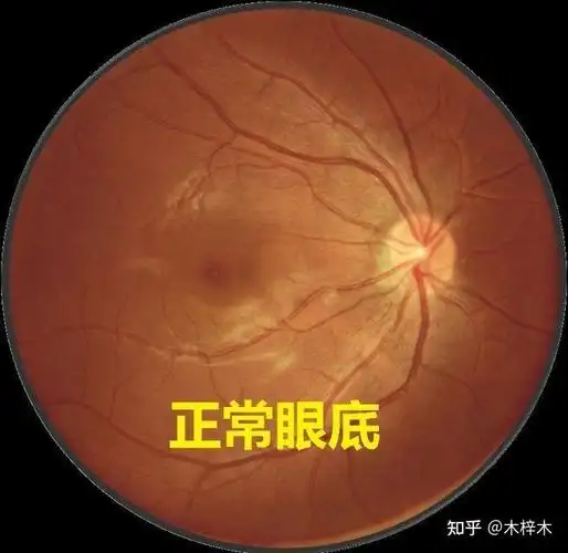 眼底是什么样的随着社会发展,近视也越来越普及,而且高度近视的人群也