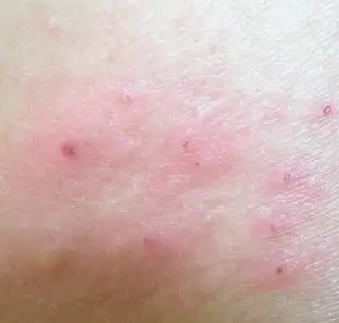 皮炎治疗期间的预防措施