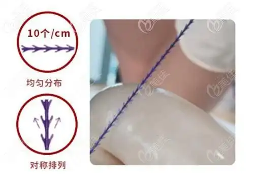 美国强生蓝钻鱼骨线全脸埋线提升除了贵没啥大的缺点