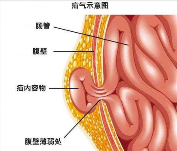 腹股沟疝图片 (8)