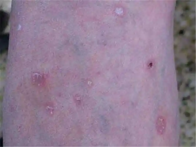 红斑狼疮早期手腕症状图片