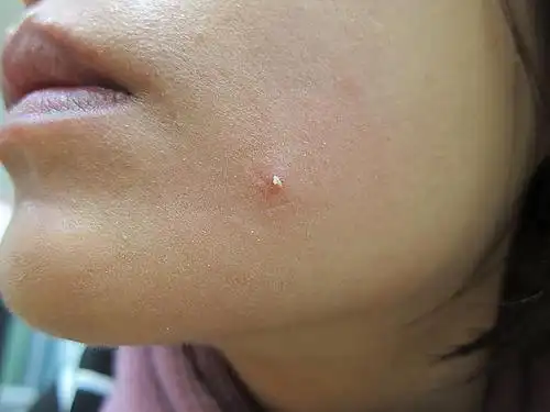 脸上挤出大量米白色颗粒物,提醒:是螨虫脸的迹象,得趁早除螨