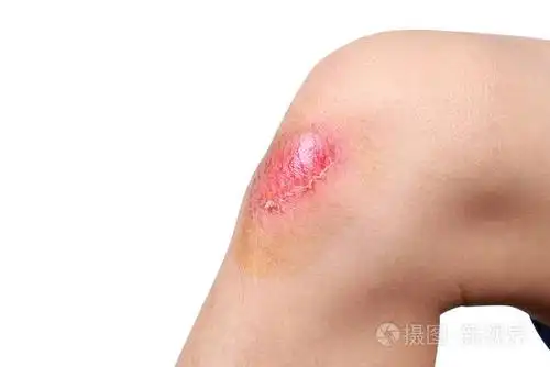 在足球比赛中,亚洲男孩遭受了意外的痛苦伤口,膝盖擦伤或受伤.