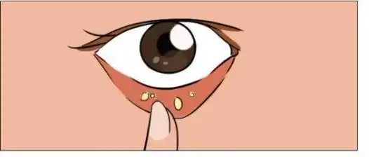 臻祥寿三果眼益眼结石怎么治疗