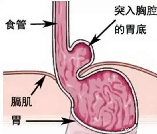 食管裂孔疝主要是腹腔内的脏器通过个食管裂孔进入胸腔导致的疾病.