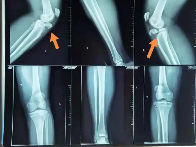 体育课跑步初中生双侧胫骨结节骨折医生呼吁加强青少年日常运动