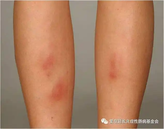 结节性红斑:位于胫骨前表面的双侧,对称性,高于皮面的红斑,疼痛性皮下