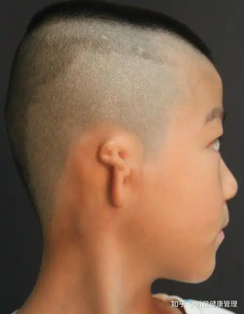小耳畸形科普孩子先天性耳朵畸形怎么办