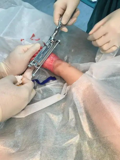 一岁儿童足背深度烧伤大张中厚皮移植效果