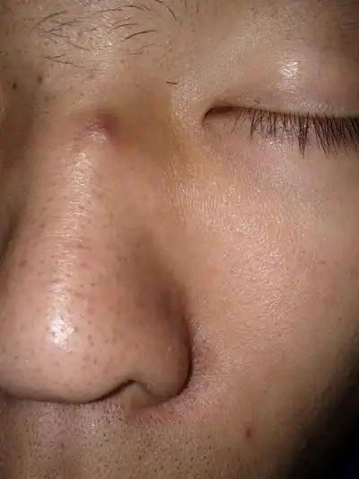 鼻子长螨虫症状图片44