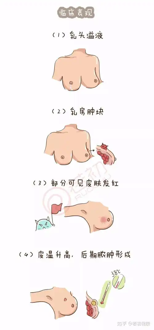 科普漫画023期乳房红肿热痛反复不愈当心乳腺炎