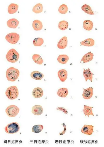 疟疾(malaria)是因疟原虫寄生人体组织而引起的寄生原虫病.