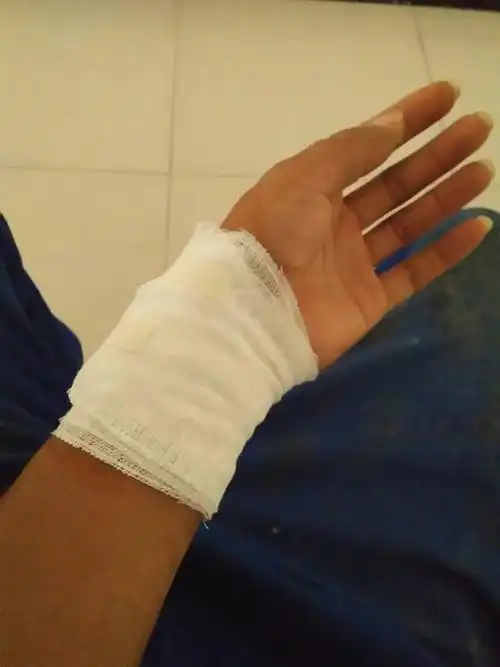 今天工作时被钢管刮伤缝了四针,医生只开了两样药