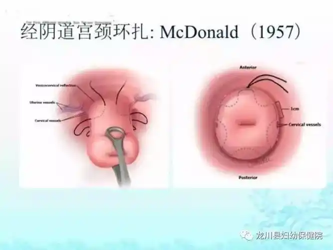 宫颈环扎术这项新技术在我院的开展,有望造福更多的广大女性,圆她们的