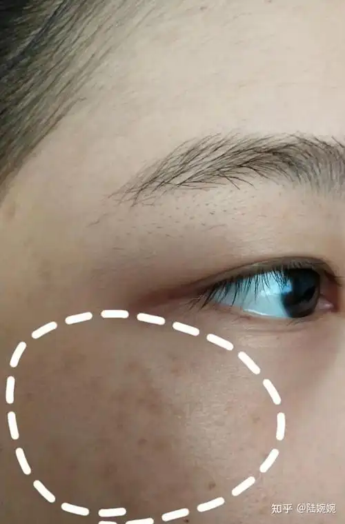 突然脸上长斑了但是我找到了快速祛斑的方法现在脸上干干净净的