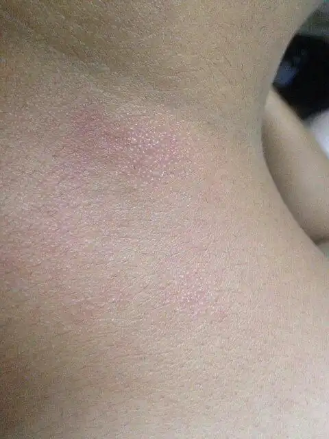 我最近脖子后面出现类似像皮肤癣一样的东西这是什么?