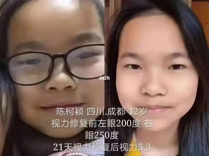 【学生视力~提升】 陈同学12岁来自四川 视力修复前左眼近视200度