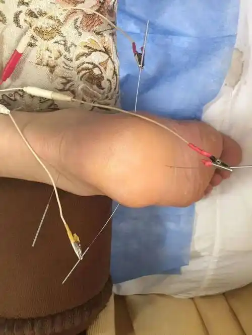 医案分享 | 针灸治疗气滞血瘀型足跟疼痛