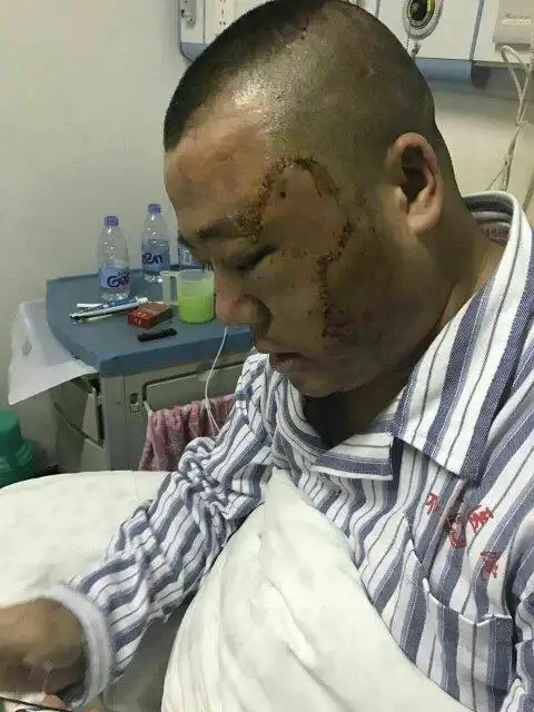 被人打 脸上两条伤口 一条6cm 另一条7cm 伤情轻伤二级 这样能否去