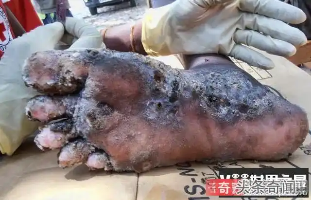 4,丝虫由丝虫病引起的疾病经常被错误地称为"象皮炎",丝虫可以导致