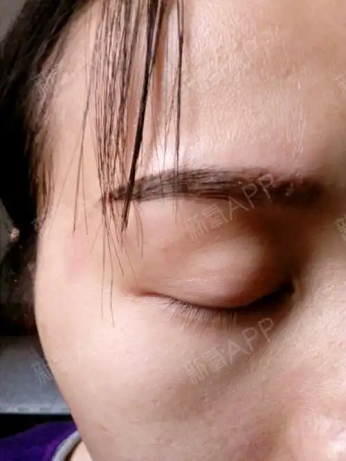 半永久纹眉后第十天,眉毛已经开始掉痂了,听说掉痂以_圈子-新氧美容