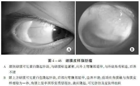 角膜皮样瘤切除后照片第1页