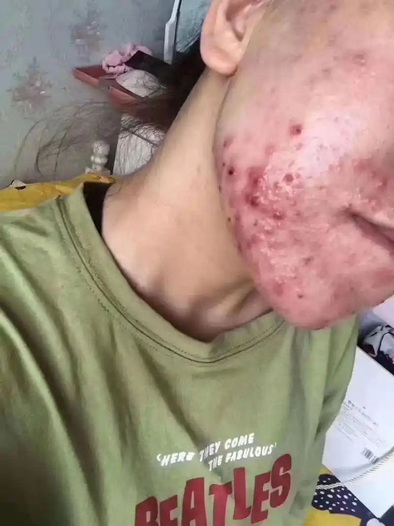 痘痘肌为什么少吃甜食