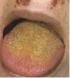 61张高清舌诊图谱,图文对照_舌苔