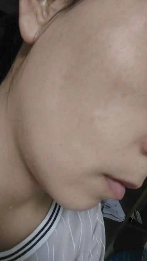 早期黄褐斑的对策