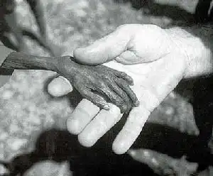 (图)日本发生的公害病——水俣病