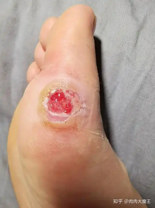 错把跖疣当鸡眼我的跖疣治疗疼痛史