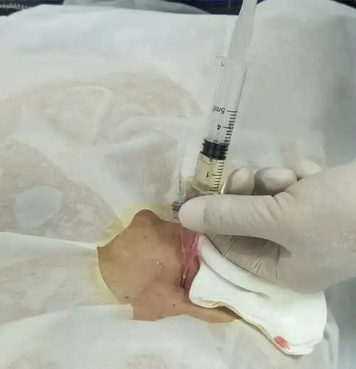 经皮肾囊肿穿刺抽液固化术经典案例展示