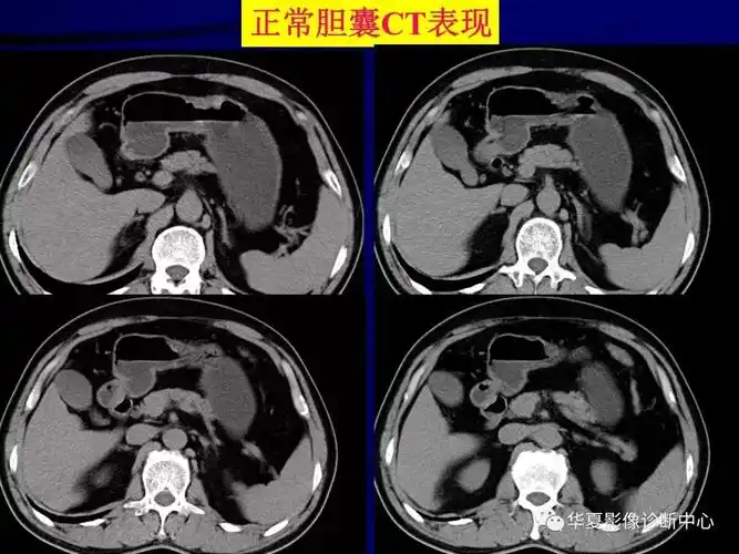 胆道系统疾病多层螺旋扫描ct诊断(一)