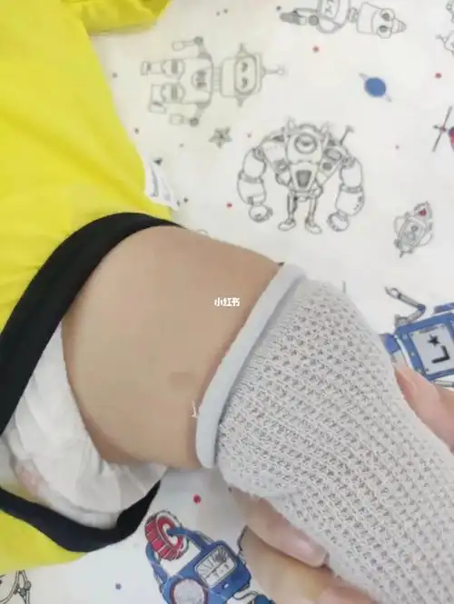 关于胎记最近发现小宝大腿根有个胎记